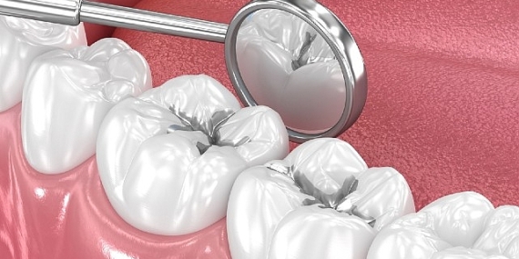 Amalgam Dolgular Değiştirilmeli mi?
